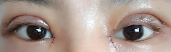 全切双眼皮15天,恢复的差不多了