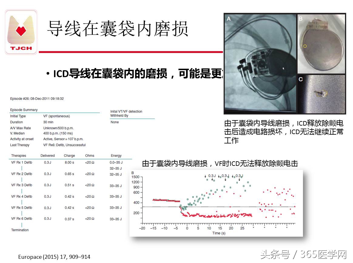 许静：新技术避免ICD不恰当放电