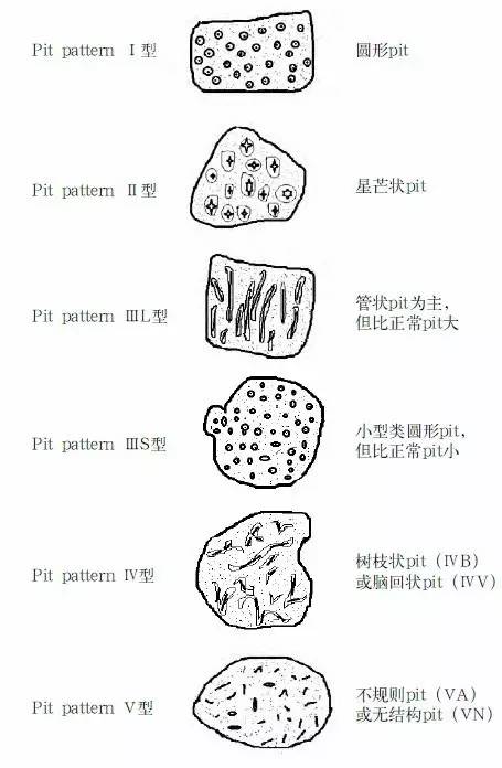 普通内镜与Pitpattern分型（多图详解）