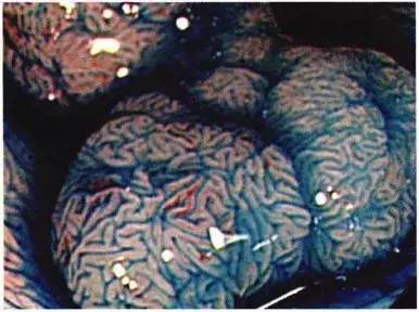 普通内镜与Pitpattern分型（多图详解）