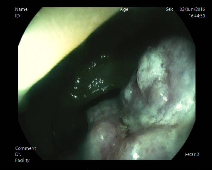 普通内镜与Pitpattern分型（多图详解）