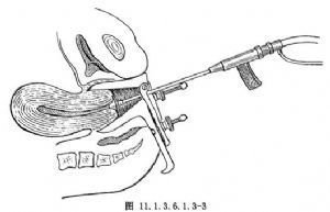 白带增多、血性白带，查体发现宫颈糜烂，你必需要治疗了！