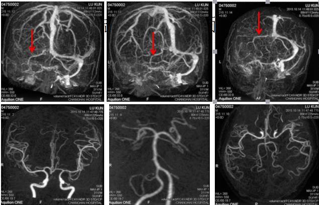 颅内静脉窦血栓怎么治疗,颅内静脉窦血栓造影多少钱