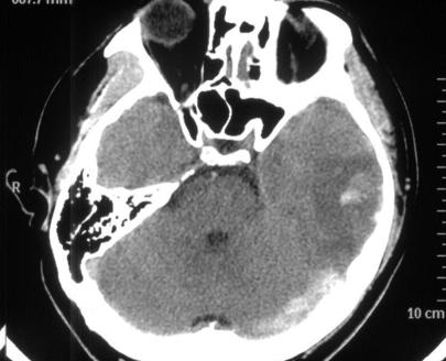 颅内静脉窦血栓怎么治疗,颅内静脉窦血栓造影多少钱