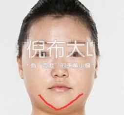 垫下巴鉴定,垫下巴看得出来吗