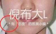 垫下巴鉴定,垫下巴看得出来吗