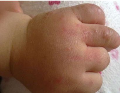 过敏体质者应该怎么来改善