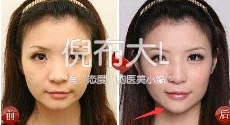 垫下巴鉴定,垫下巴看得出来吗