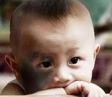 宝宝身上大片青色胎记还有咖啡斑,宝宝身上青色胎记