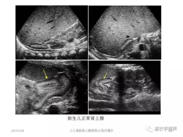 小儿肾上腺囊性占位超声表现,肾上腺疾病的影像学诊断