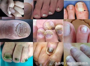 为什么三个月的婴儿都是灰指甲,指甲发黄警惕灰指甲