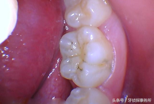 宝宝牙齿洞大怎么补救,牙齿窝沟深怎么回事