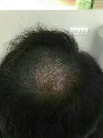 沙溢秃顶电视剧,沙溢秃顶