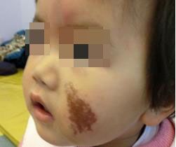 祛除咖啡斑费用高吗,儿童咖啡斑治疗费用