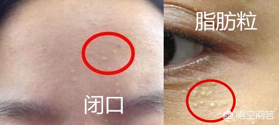 护肤为何毛孔变大脱皮,护肤为什么老闷痘