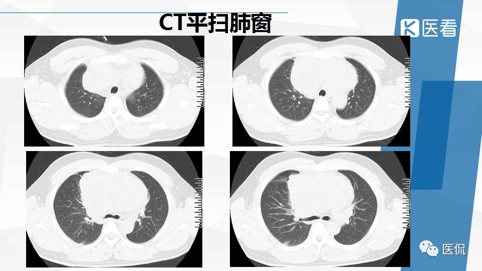 精原细胞瘤ct影像,精原细胞瘤影像特征