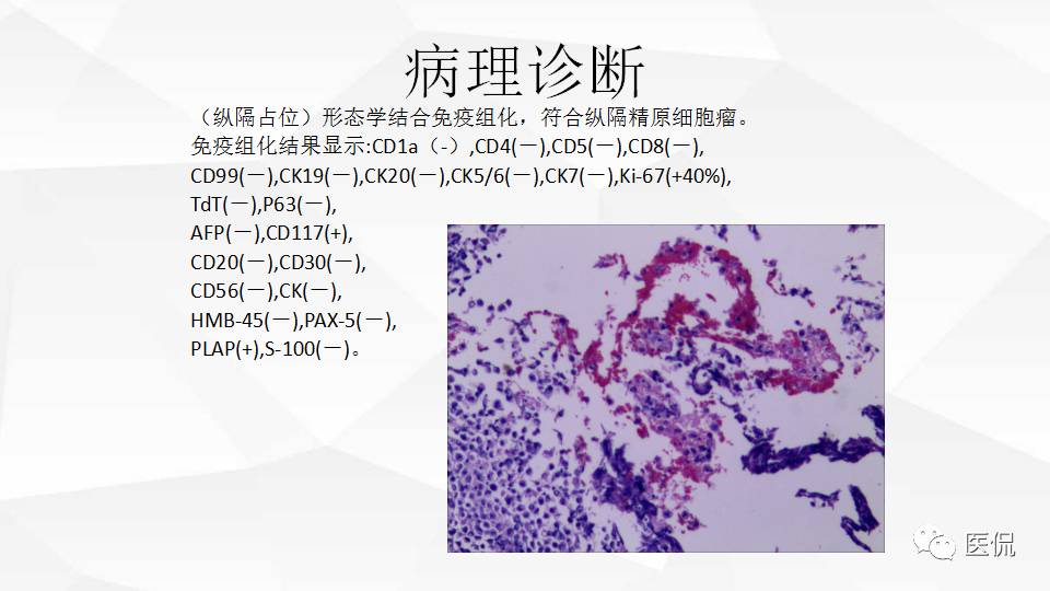 精原细胞瘤ct影像,精原细胞瘤影像特征