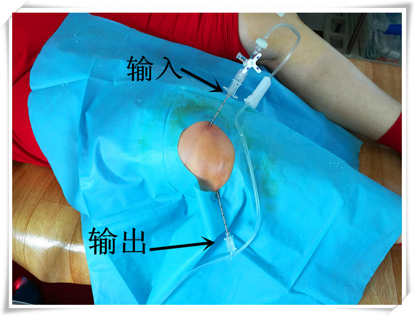 膝关节炎疼痛用什么中草药,老年退化性膝关节炎怎么治疗