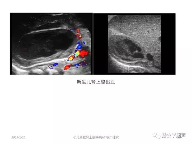 小儿肾上腺囊性占位超声表现,肾上腺疾病的影像学诊断