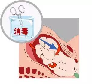 我滴个天呐！男子被木屑刺伤一个月后突发重病险丧命！