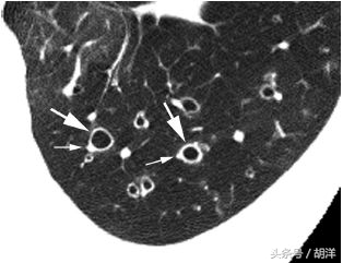 古装剧吐血是什么病,古代剧咳嗽吐血是什么病