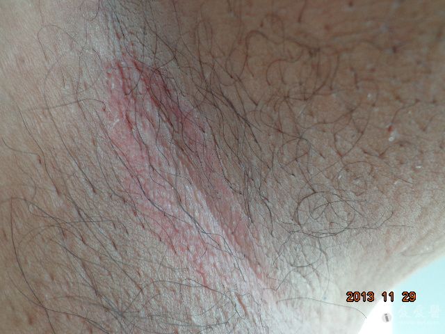 糖尿病人皮肤病变会反复发烧,糖尿病皮肤病变糖斑图片