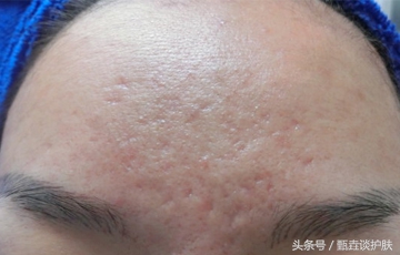 痘坑痘疤怎么遮瑕,修复痘坑痘疤神器