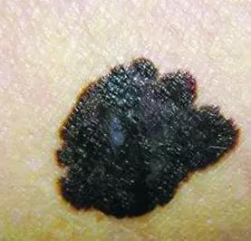 做胃镜怀疑癌变医生让做ct,做胃镜检查疑似肿瘤