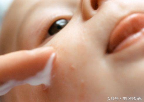 宝宝湿疹一直反复发作是什么原因,宝宝湿疹反复发作怎么办