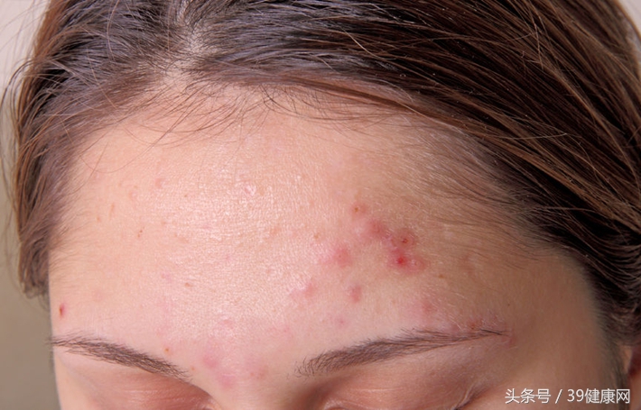 对付青春痘的正确方法,被传染的痤疮