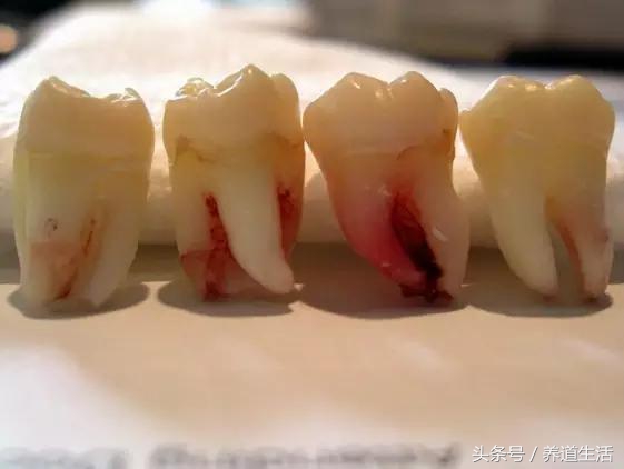 拔智齿打麻药注意左大脑有点跳动,治牙经常打麻药对大脑有损伤吗