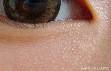 眼睛长脂肪粒怎么去除最简单方法,眼睛长脂肪粒怎么去除小窍门