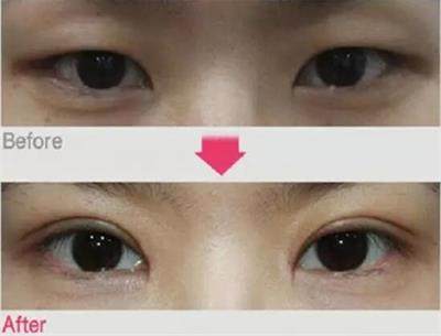 眼睛小怎么办单眼皮,眼睛小怎么办变大