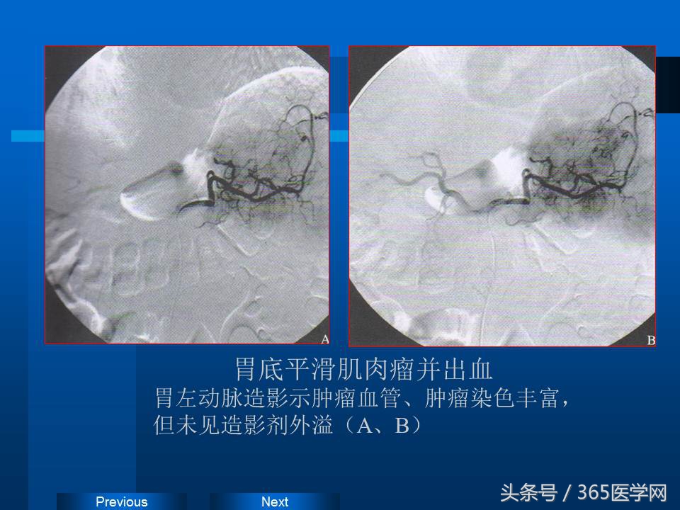 崔进国：消化道出血的介入治疗