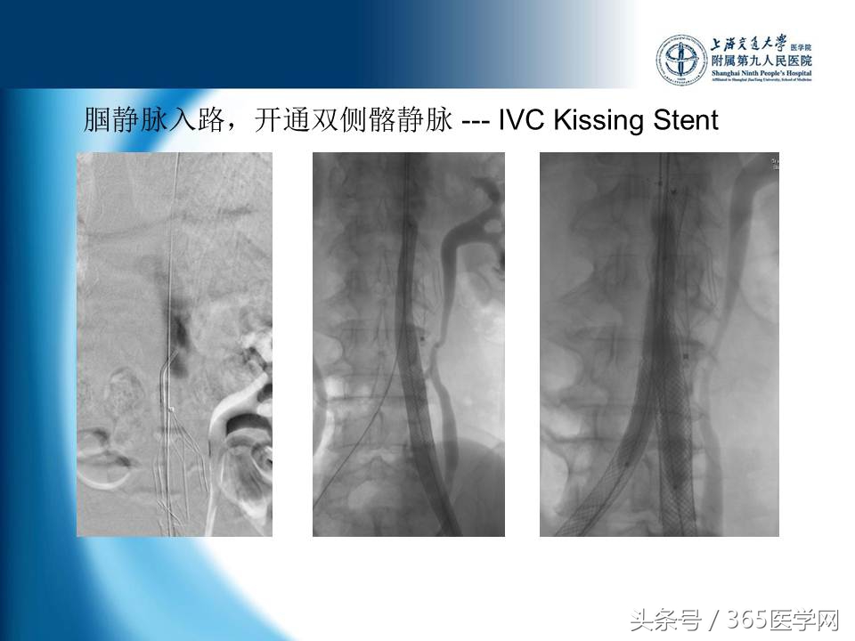 下肢静脉血栓植入滤器后的护理,下肢静脉血栓滤器植入后注意事项