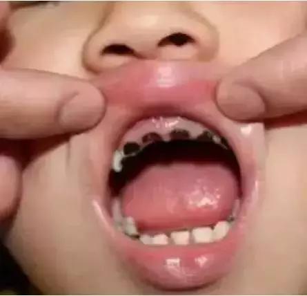 乳牙到底要不要根管治疗,儿童乳牙是全部要换的吗