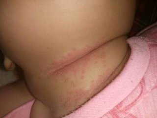 宝宝淹脖子导致破皮抹什么好得快,宝宝淹脖子擦红霉素软膏还是眼膏