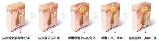 脸颊两侧长痘用什么药膏,脸颊两侧长痘的原因是什么