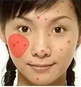 脸的侧面为什么长一些小痘痘,为什么额头上长了好多痘痘