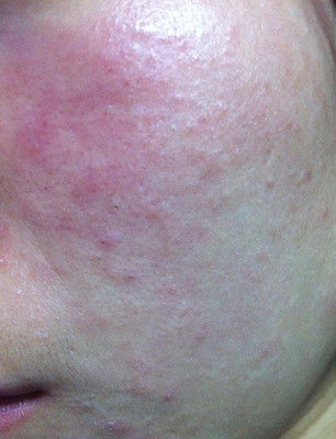 超声刀的效果好吗,韩国超声刀效果