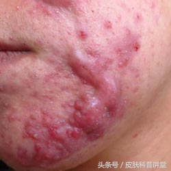 痘印痘痕怎么治,痘印和痘疤怎么治疗最好