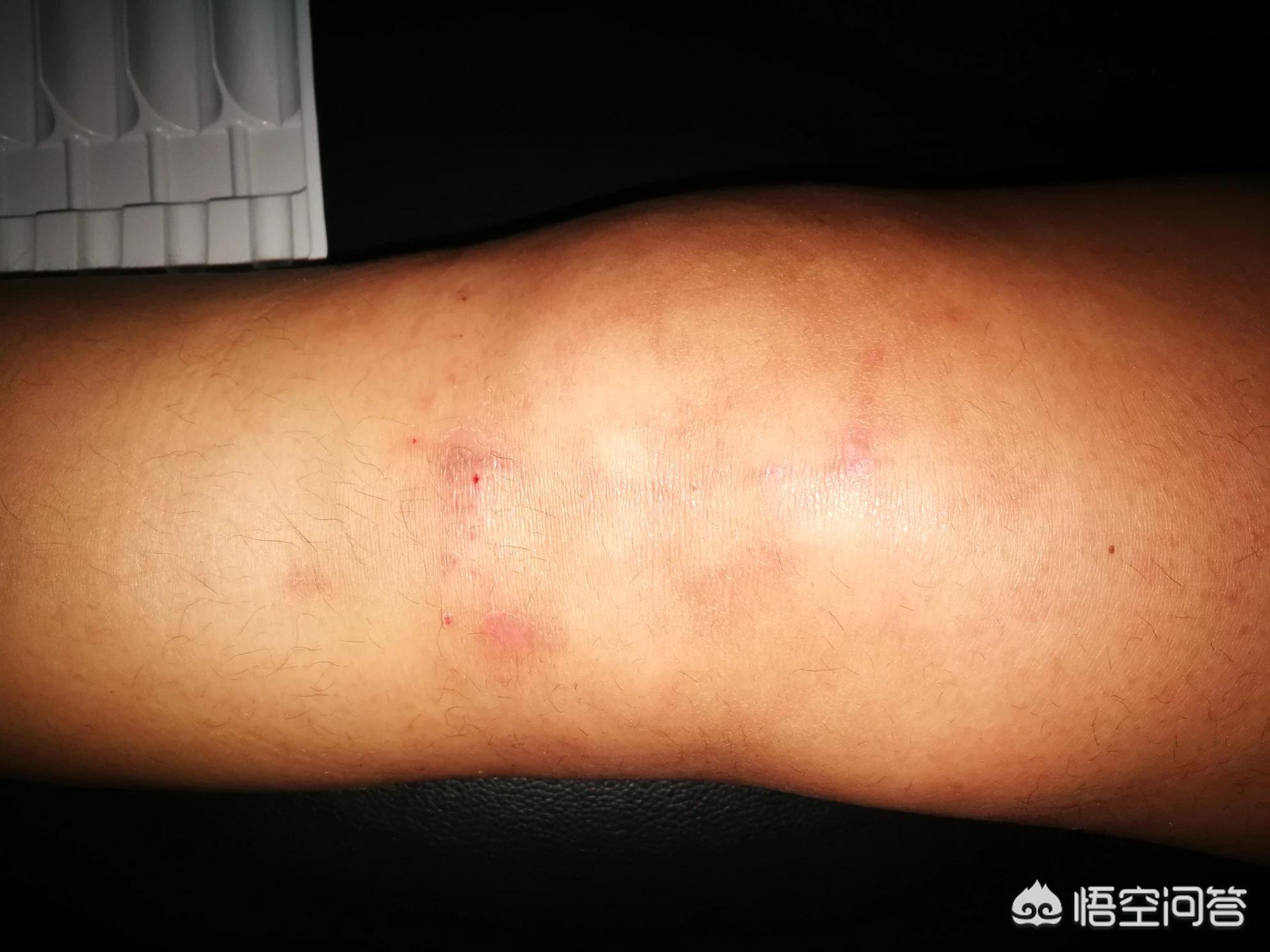 膝盖积水以后是热敷还是冷敷？真能解决问题吗？医生：可能都没用