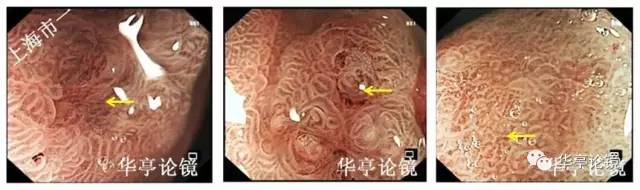 胃小灶癌变,胃体小凹型腺瘤