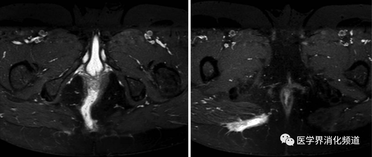 复杂性肛周克罗恩病诊治进展