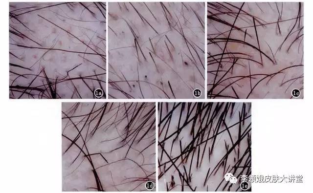 快速拯救秃发,m型脱发怎么办