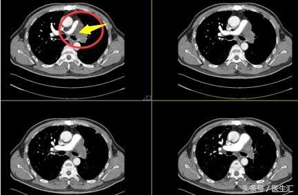 两年了老是咳嗽怎么回事,老人稍微活动气急气喘怎么办