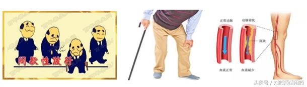 下肢动脉硬化闭塞症药物治疗,下肢动脉硬化闭塞症跛行怎么治疗