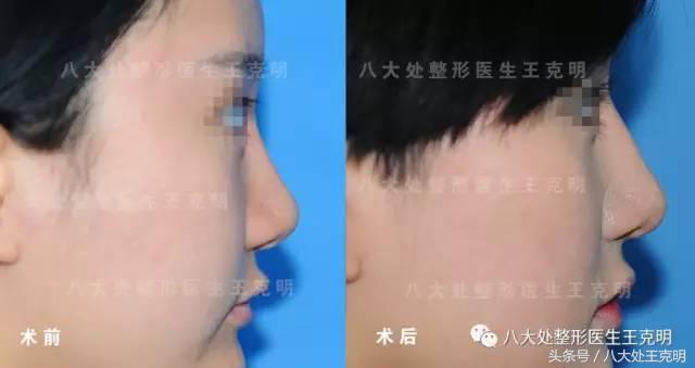 鼻整形后出现肿胀、假体外露歪斜、皮肤异样该怎么办?