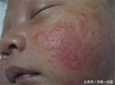 宝宝反复湿疹对付湿疹有妙招,宝宝湿疹和环境湿度