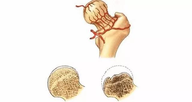 股骨头坏死晚期到瘫痪有多长时间,股骨头坏死晚期肌肉萎缩能恢复吗